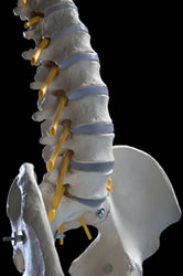 Herniated Disc, Oakleigh, VIC Chiropractor