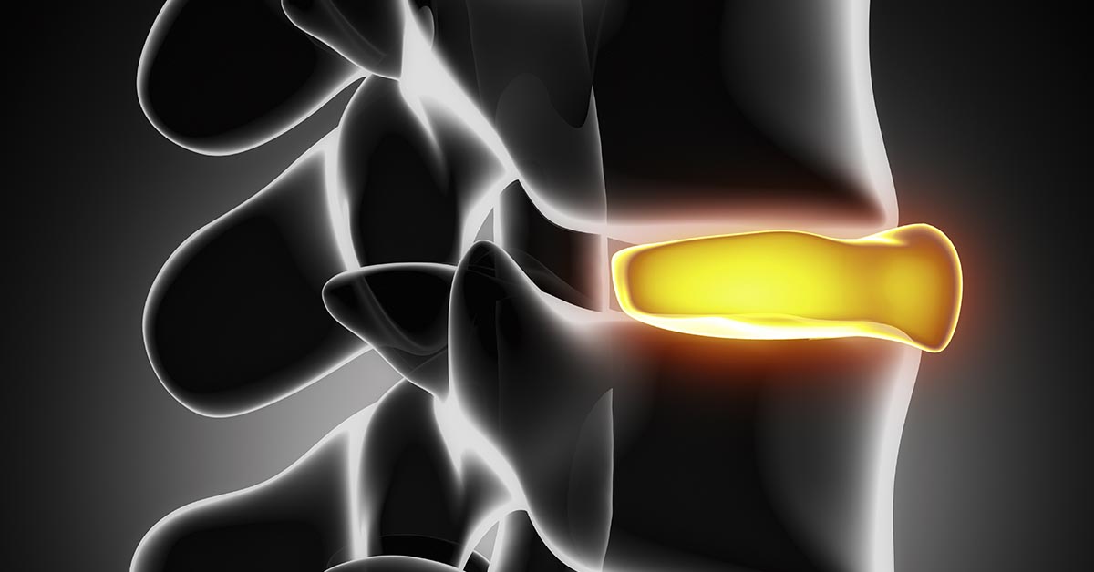 Herniated Discs and Chiropractic