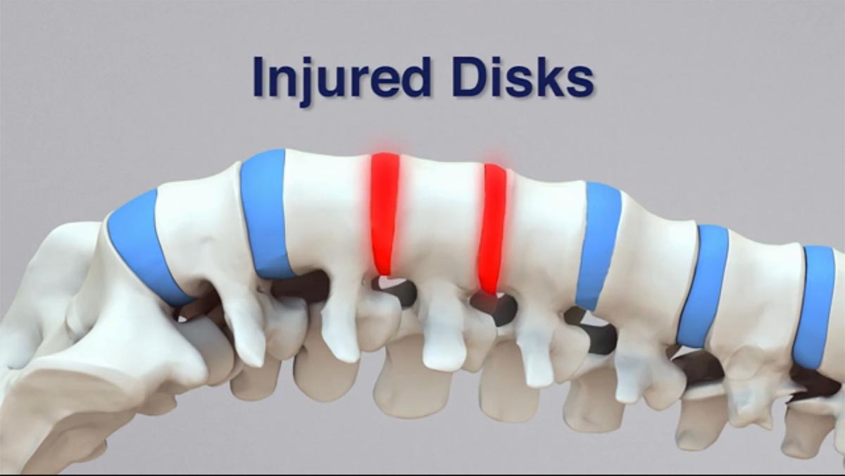 Oakleigh non-surgical spinal decompression