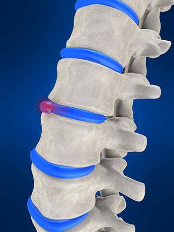 Herniated Discs